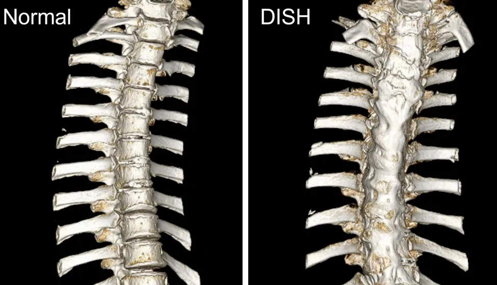 Spine Comparison